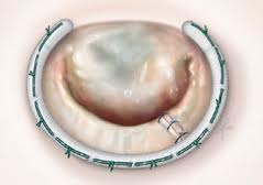 Chirurgie de la valve mitrale