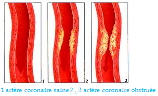 Artère coronaire